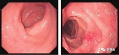 萎縮性胃炎不可怕，只要